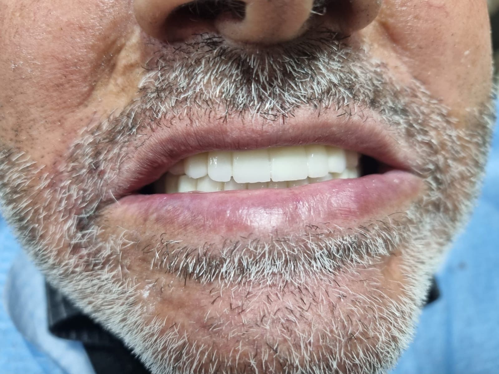 השתלות שיניים — אחרי הטיפול