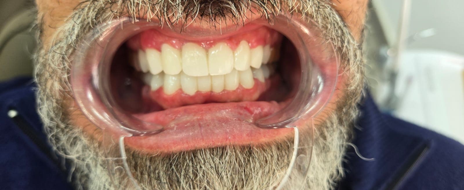 טיפול ושחזורים — אחרי הטיפול