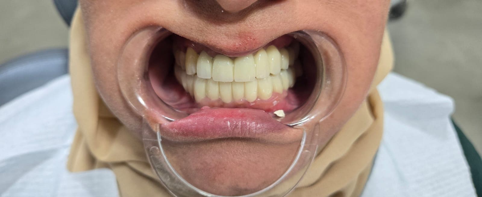 שיקום ותותבות — אחרי הטיפול