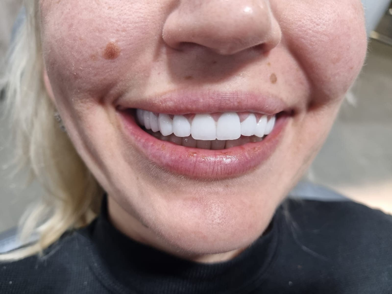 תוצאה של טיפול אסתטי במרפאת Sofia Dent