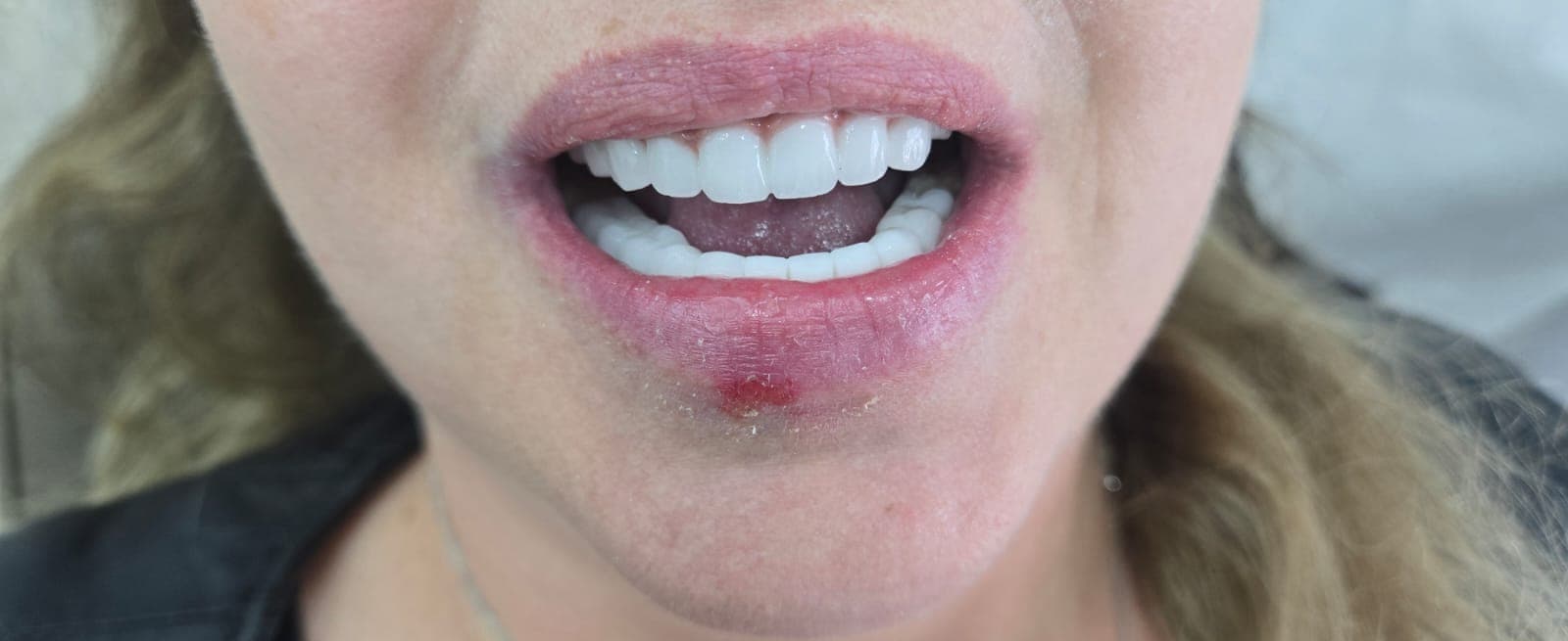 היגיינה וניקוי — אחרי הטיפול